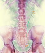 Coloured X-ray of a stent inserted in the ureter