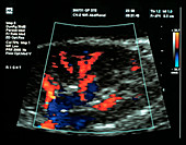 Transplanted kidney,Doppler ultrasound