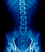 Kidney stone,abdominal X-ray