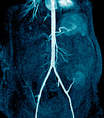 Transplanted kidney,MRI scan