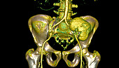 Transplanted kidney,CT scan