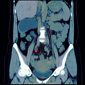 Kidney stone,MRI scan