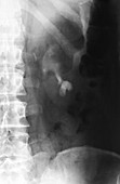 Staghorn kidney stone,X-ray