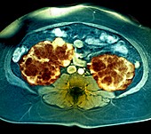 Polycystic kidneys,MRI scan