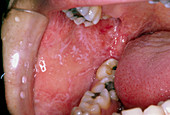 Lichen planus affecting inside of the mouth