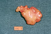 Excised lipoma,a benign tumour of fat cells