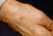 Liver spots on the hand of an elderly woman
