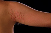 Cutaneous larva migrans rash on upper arm