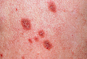 Close up of lichen planus on skin