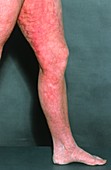 Livedo reticularis on a patient's leg