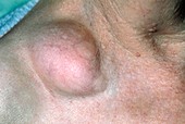 Close-up of a lipoma,a benign tumour