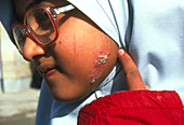 Cutaneous leishmaniasis scar on the face of a girl