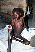 Starving boy suffering from visceral leishmaniasis