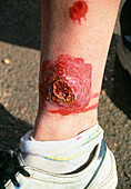 Treated cutaneous leishmaniasis lesion on leg