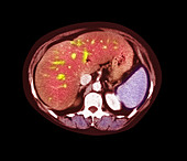 Fatty liver CT scan
