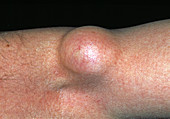 Lipoma swelling
