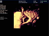 Inflamed lymph node,Doppler ultrasound