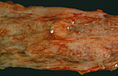 Leiomyoma of the oesophagus