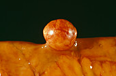 Intestinal fat tumour