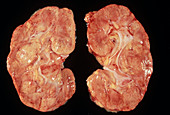 Kidney damaged by immune system