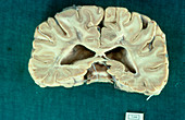 Section of whole brain affected by MS