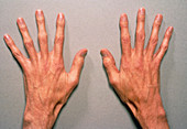 Marfan's syndrome