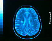 MRI scan of brain in multiple sclerosis