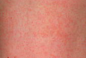 German measles (Rubella) rash on skin of a child