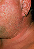 Swelling of glands in man with mumps