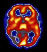Colour SPECT scan of brain during migraine attack