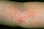 Molluscum contagiosum: skin infection on arm