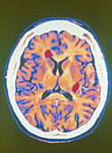 Coloured MRI scan of brain in multiple sclerosis