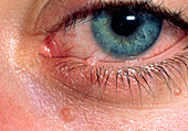 Molluscum contagiosum infection of lower eyelid