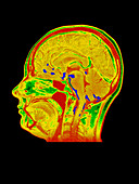 Coloured MRI scan of human brain with meningitis