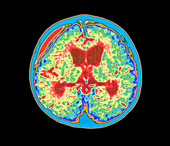 Coloured MRI brain scan of abscess in meningitis