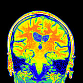 Multiple sclerosis brain MRI