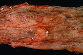Oesophagus muscle tumour
