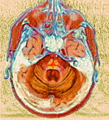 Multi-system atrophy,MRI scan