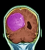 Meningioma brain tumour,MRI scan
