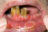 Mouth ulcers from myelodysplasia