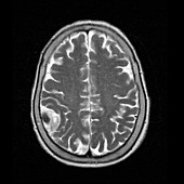 Meningioma tumour,MRI scan