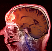 Mucocele growth,MRI scan