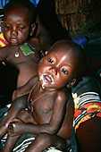 Two malnourished African children