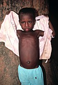 Malnourished boy with river blindness