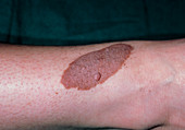 Giant pigmented naevus (mole)