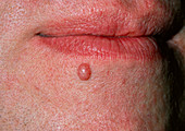 Close-up of intradermal naevus under man's lip