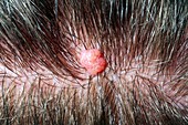 Close-up of a benign mole on scalp of young man