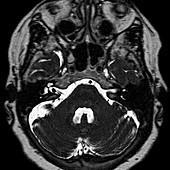 Acoustic neuroma,MRI Scan