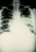 X-ray of lungs in pulmonary oedema