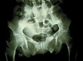 X-ray of pelvis in osteomalacia